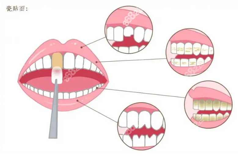 桂林源树口腔可以做的牙齿瓷贴面类型