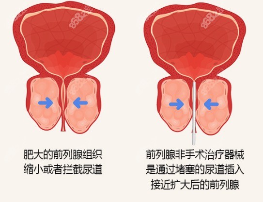 韩国世檀塔男科医院前列腺微创手术是怎么样做的？