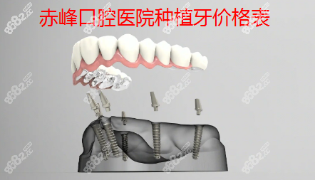 赤峰种植牙价格表~8682.cc