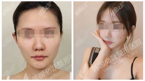 必妩整形医院轮廓整形实例