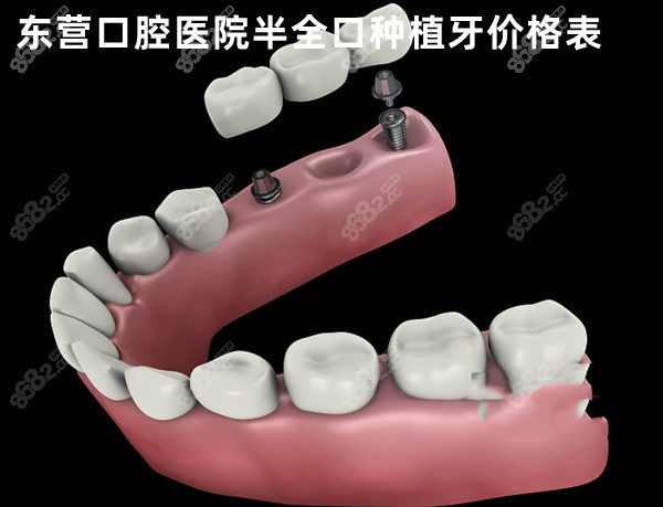 东营口腔医院半全口种植牙价格表