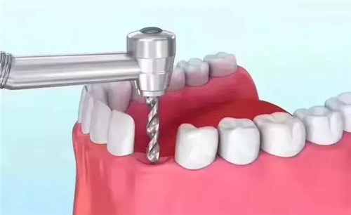 洛阳牙大夫口腔种植牙技术好不？全口/半口牙颌种植都挺赞