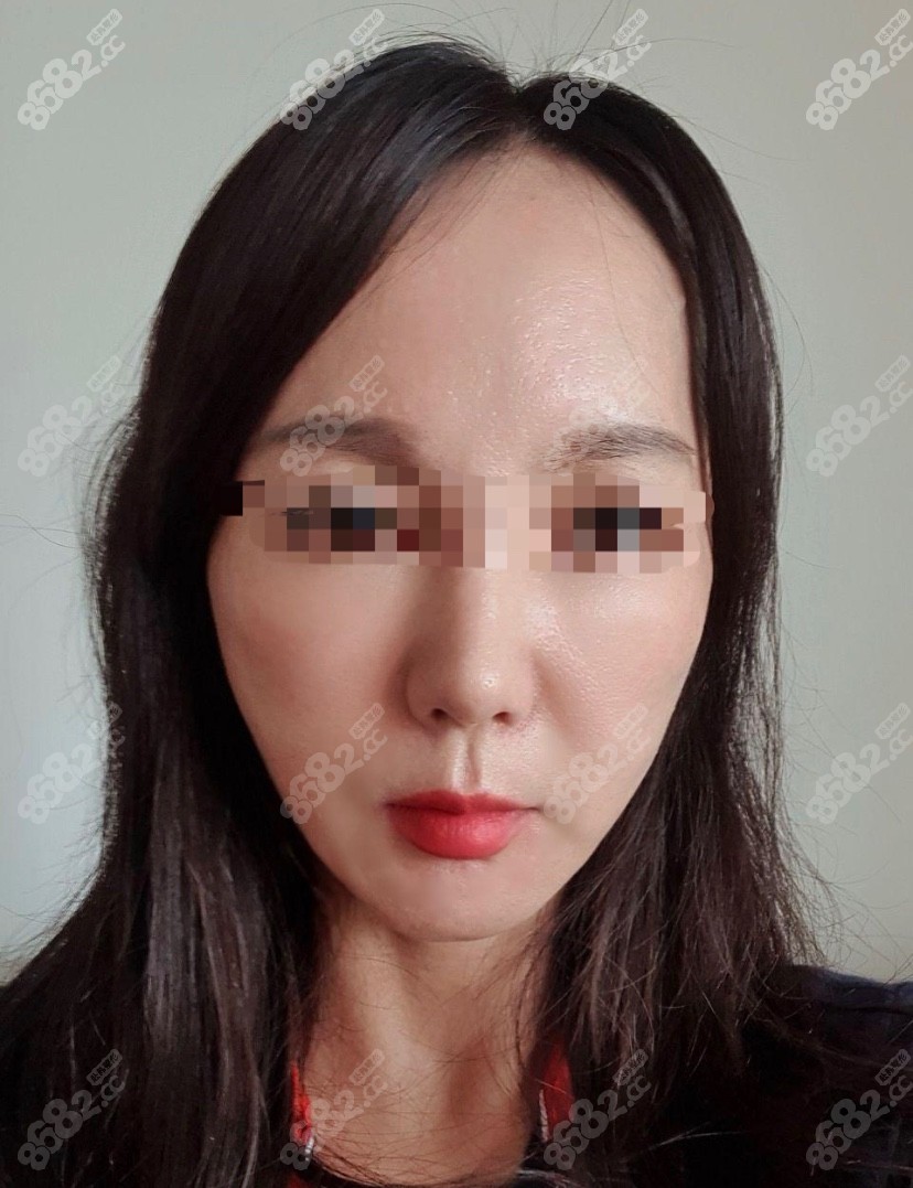 柳敏元拉皮实例