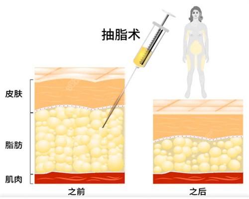 土麦森吸脂多少钱？