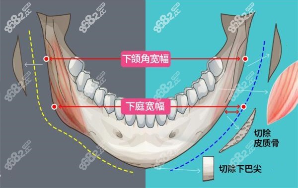 面部轮廓整形手术过程示意