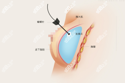 韩国THE整形外科医院假体隆胸再造