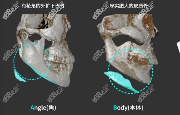 医生的审美是决定术后疗效的关键