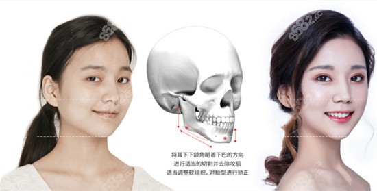 韩国欧佩拉整形金锡汉院长做磨骨好吗
