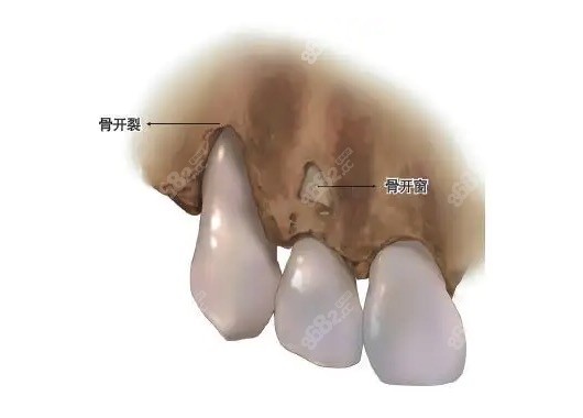 骨开裂和骨开窗有啥区别