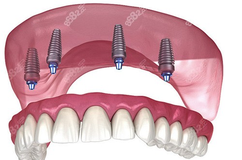 all-on-4牙齿种植