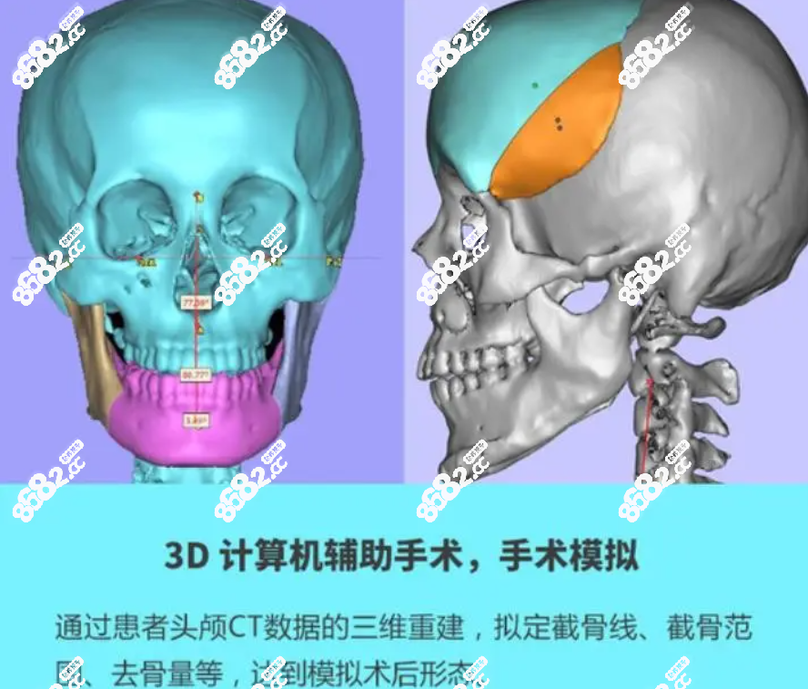 何晋龙数字化3D颅颌面重建技术优势