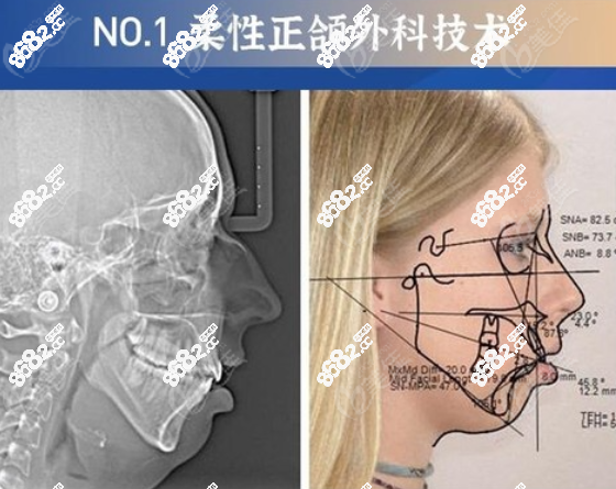 <!--<i data=20240705-sp></i>-->医生柔性正颌外科技术