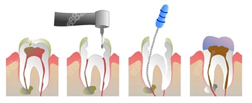 根管治疗