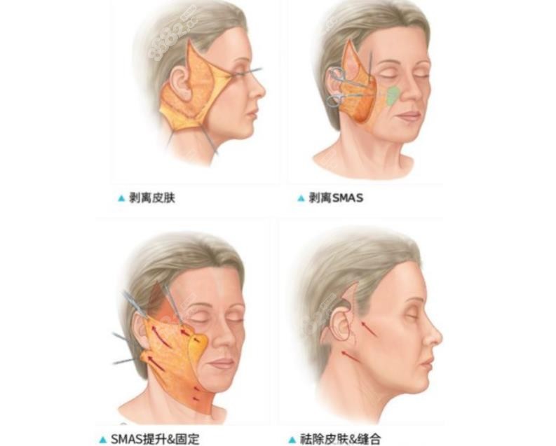 拉皮手术过程图片