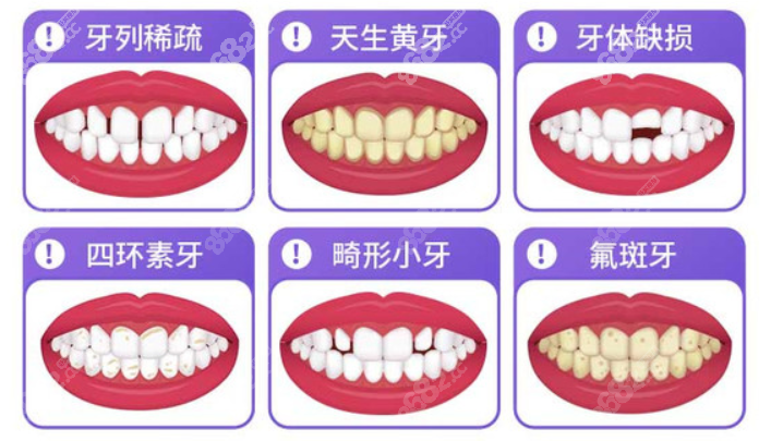 武威宝山口腔做牙齿贴面的类型图