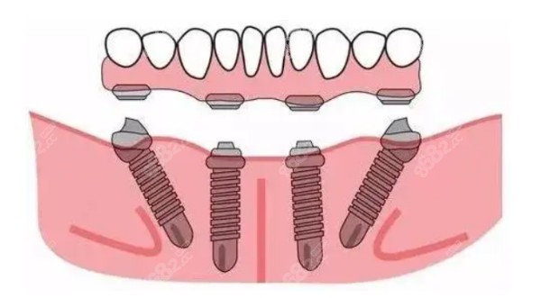 青岛即墨半口/全口种植牙价格