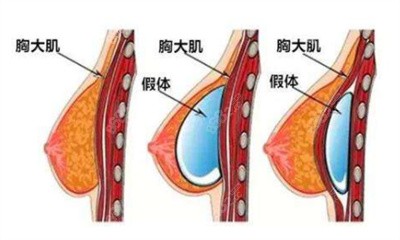 万连壮医生在隆胸方面的技术优势3