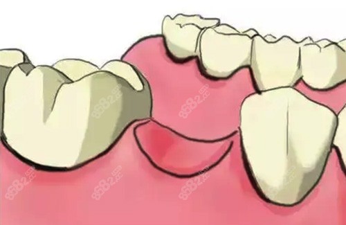 牙齿缺失久了还能种植吗