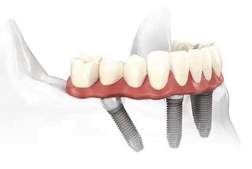 all-on-4\6种植牙技术