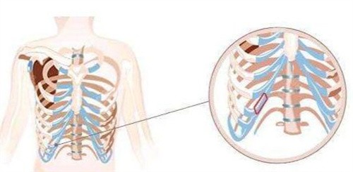 韩国碧夏整形肋软骨取材