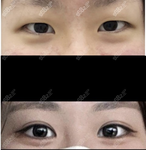 韩国可来熙整形外科眼综合手术对比图