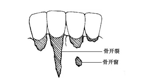 牙齿骨开裂和骨开窗