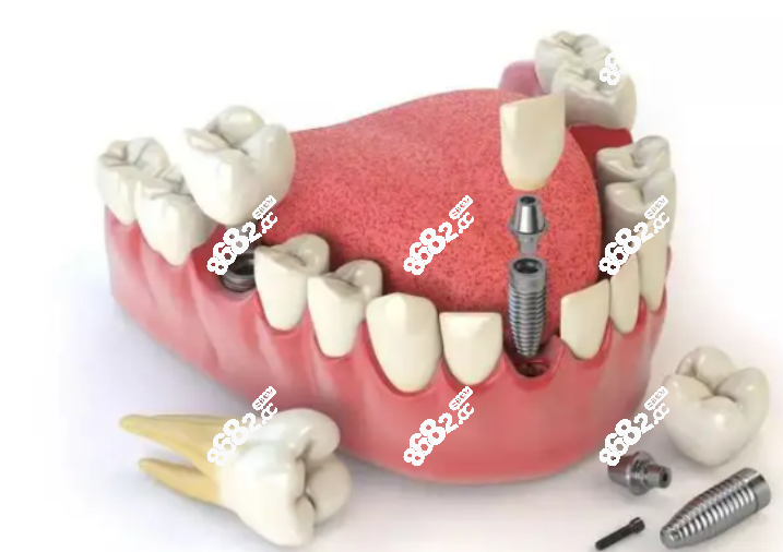国内有名的种植牙医生医院