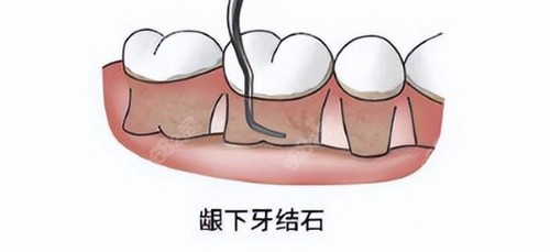 龈下刮治后悔死图片