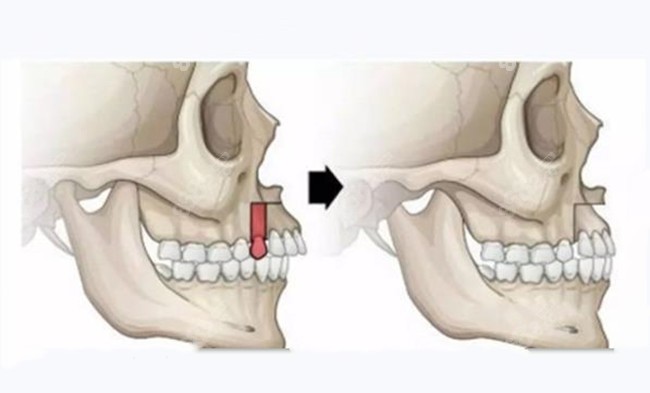 正颌手术的原理图