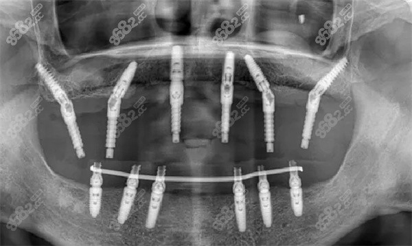 全口种植牙