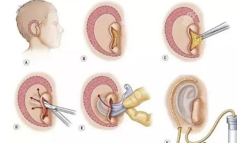 耳再造手术步骤
