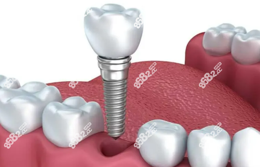 种植牙示意图