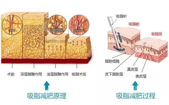 成都全身吸脂做得好的医院医生