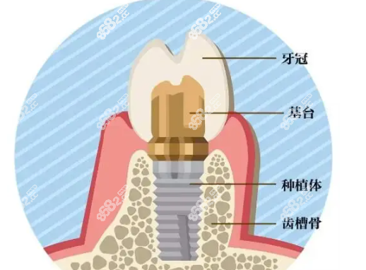 种植牙费用一般怎么付的