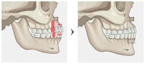 www.8682.cc做骨性凸嘴手术有后遗症吗