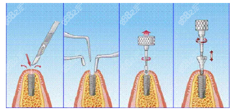种植牙手术过程
