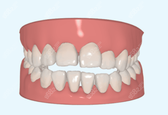 烤瓷牙全瓷牙是如何矫正牙齿的