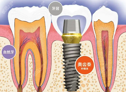 韩国奥齿泰种植体