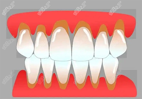 牙龈萎缩
