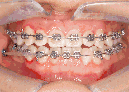 金属牙套矫正牙齿移动变化