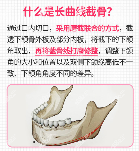 长曲线下颌角手术