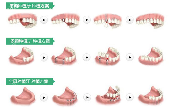 种植牙手术方案www.8682.cc