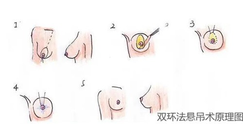 乳房双环法悬吊是怎么做的