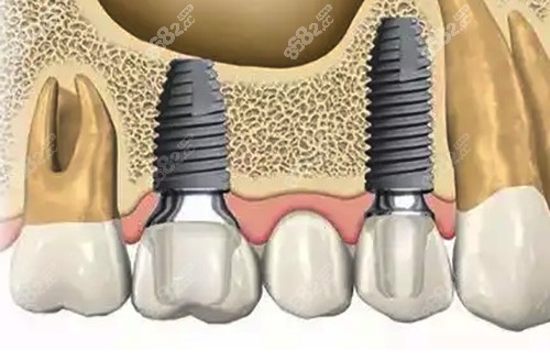 通过种植牙修复牙齿缺失