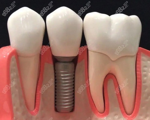 前牙缺失做種植的收費(fèi)標(biāo)準(zhǔn)怎樣？