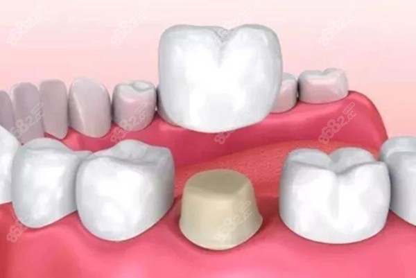 牙齿戴牙冠的图片