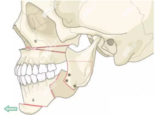 正颌手术