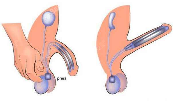 韩国世檀塔男科的阴茎假体三件套(膨胀型假体)工作原理
