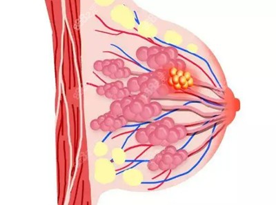 乳腺增生的临床表现