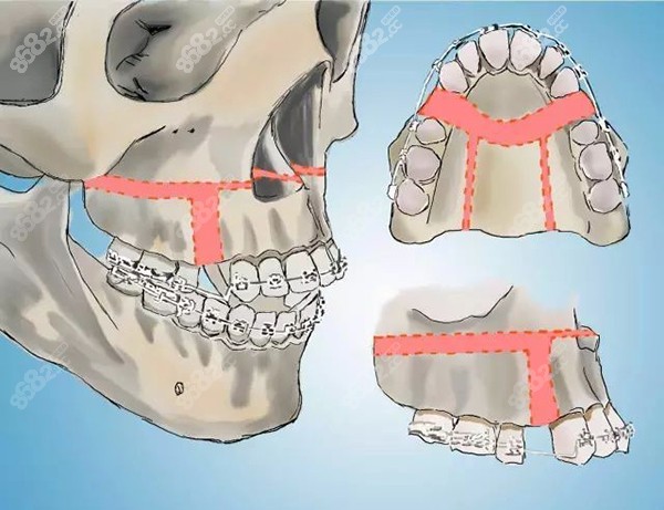 正颌手术